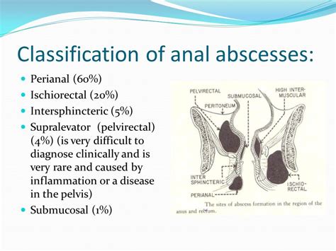 abscesso perianal